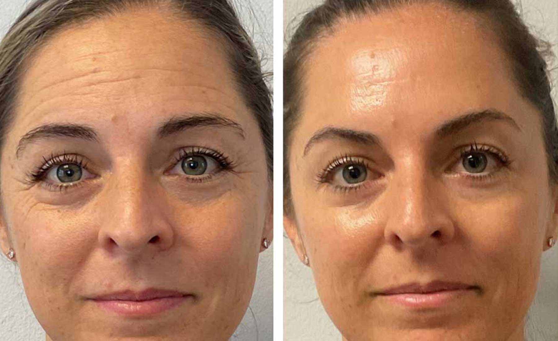 Forhead Lines-Before and after