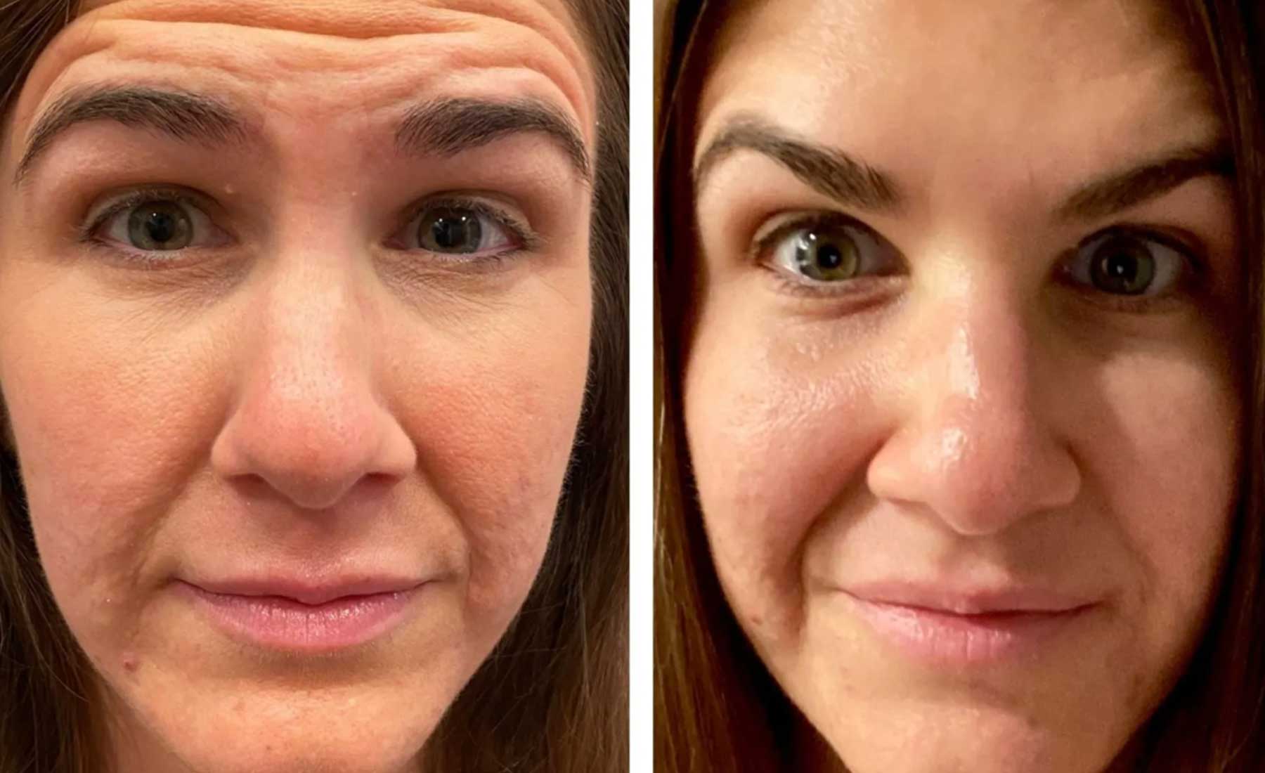 Forhead Lines-Before and after