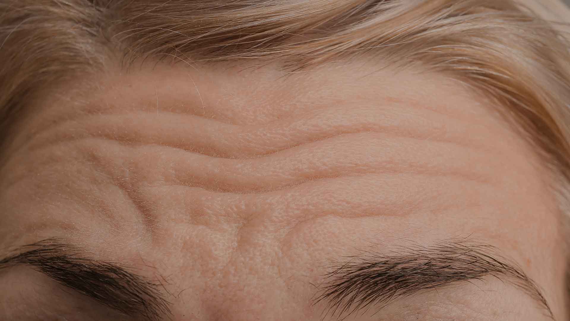 forehead-lines-monaz-clinic