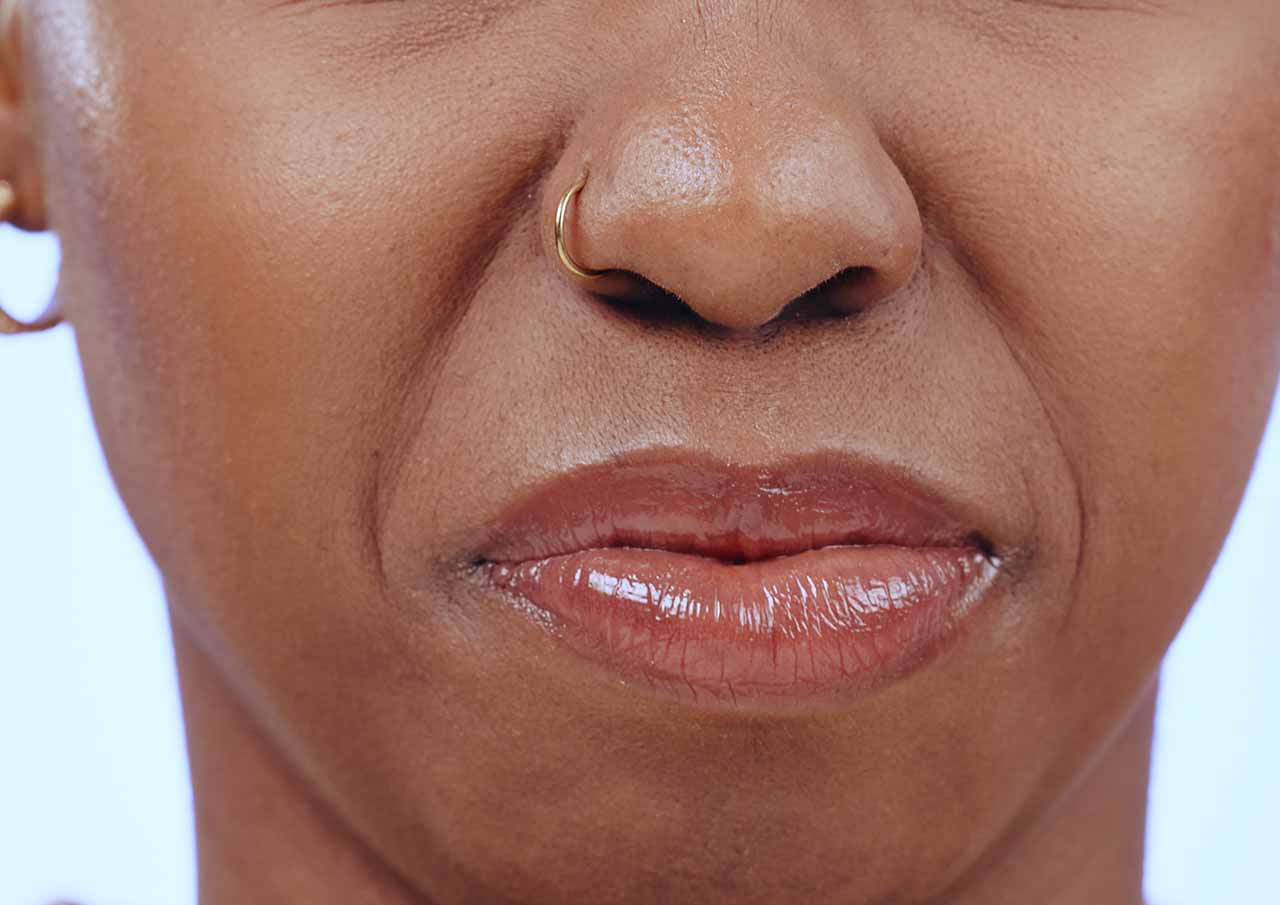 Are Nasolabial Folds Making You Look Older Than You Feel