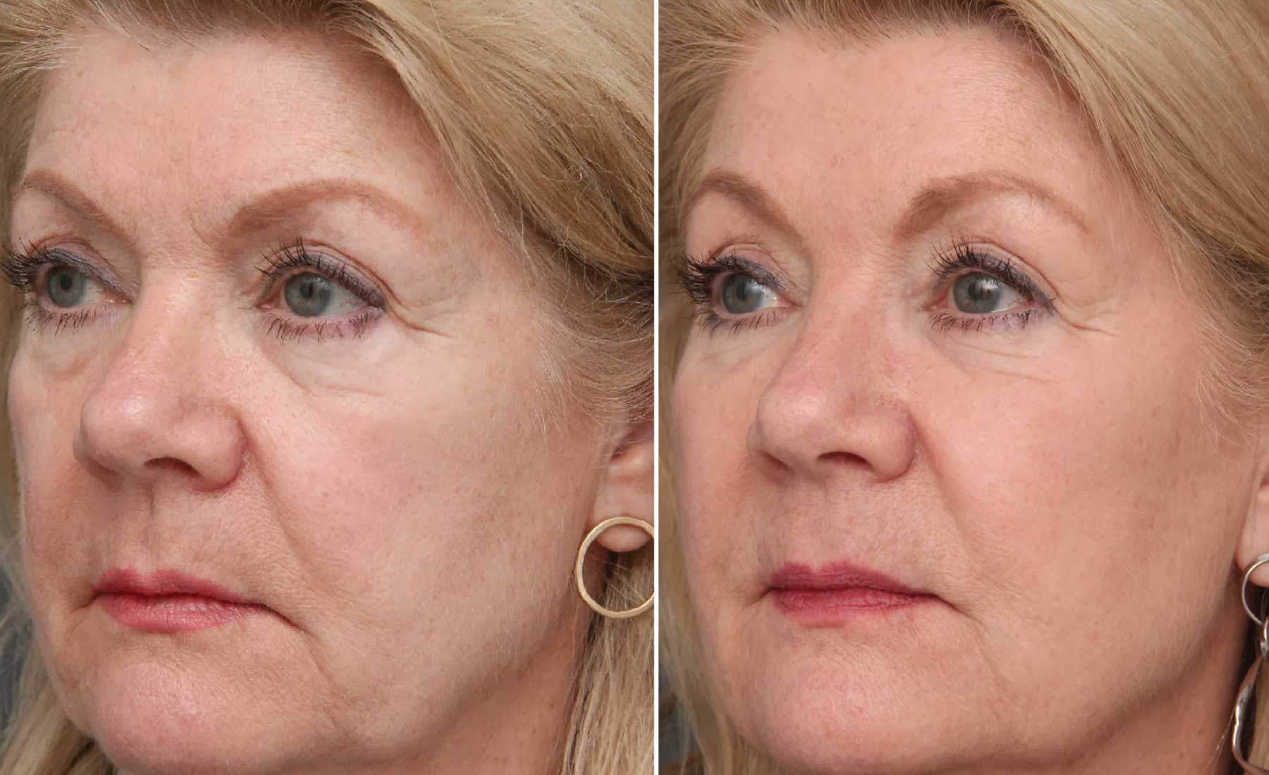 Browlift-Before and after