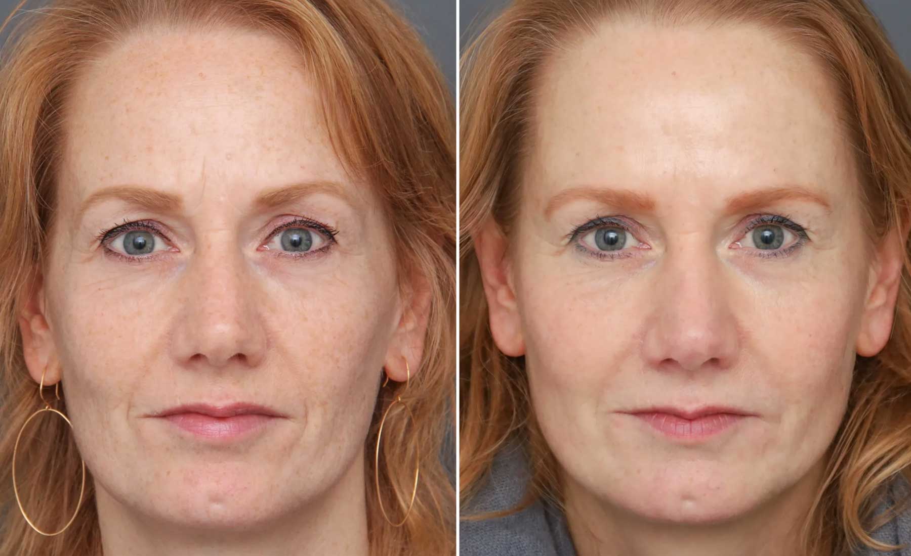 Browlift-Before and after
