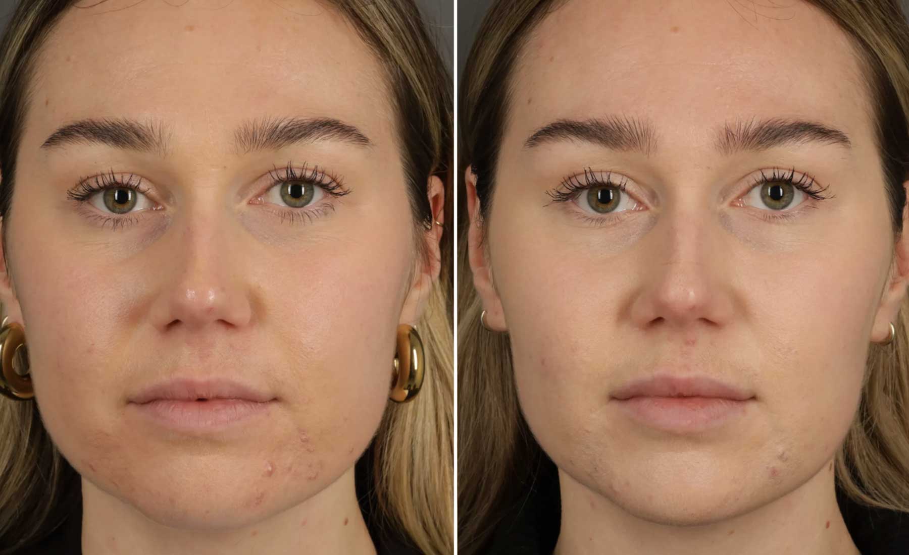 Bruxism Treatment (Teeth Grinding and Jaw Clenching)‎-Before and after