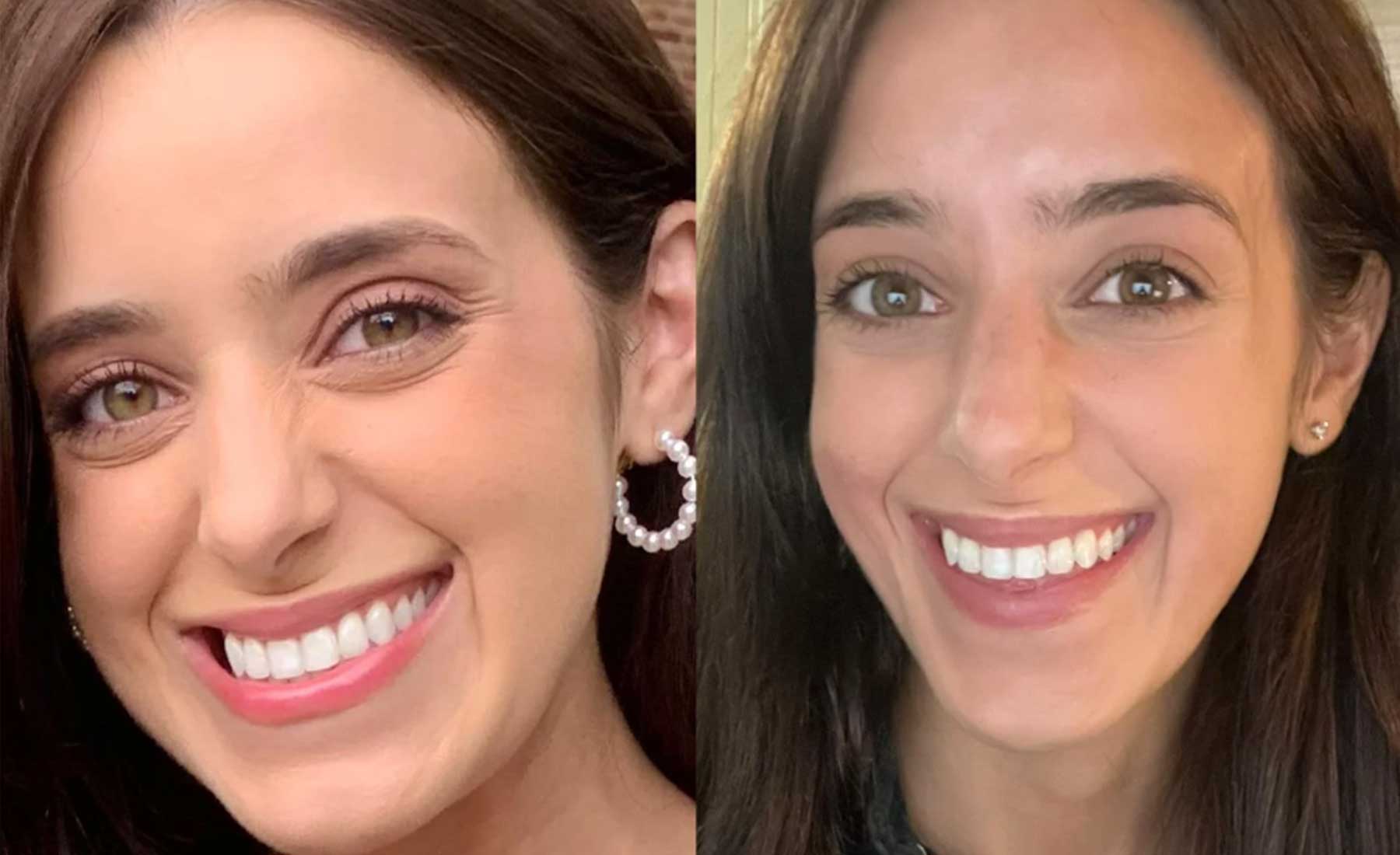 Bunny Lines (Nose Wrinkles)‎-Before and after