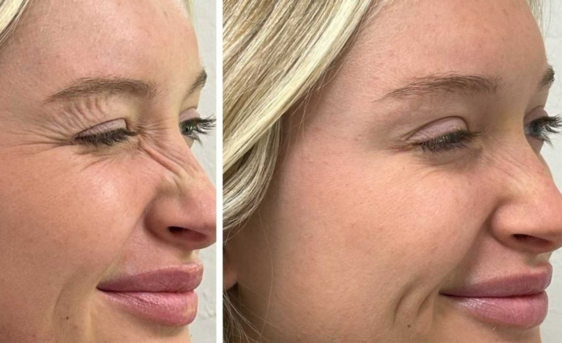 Bunny Lines (Nose Wrinkles)‎-Before and after