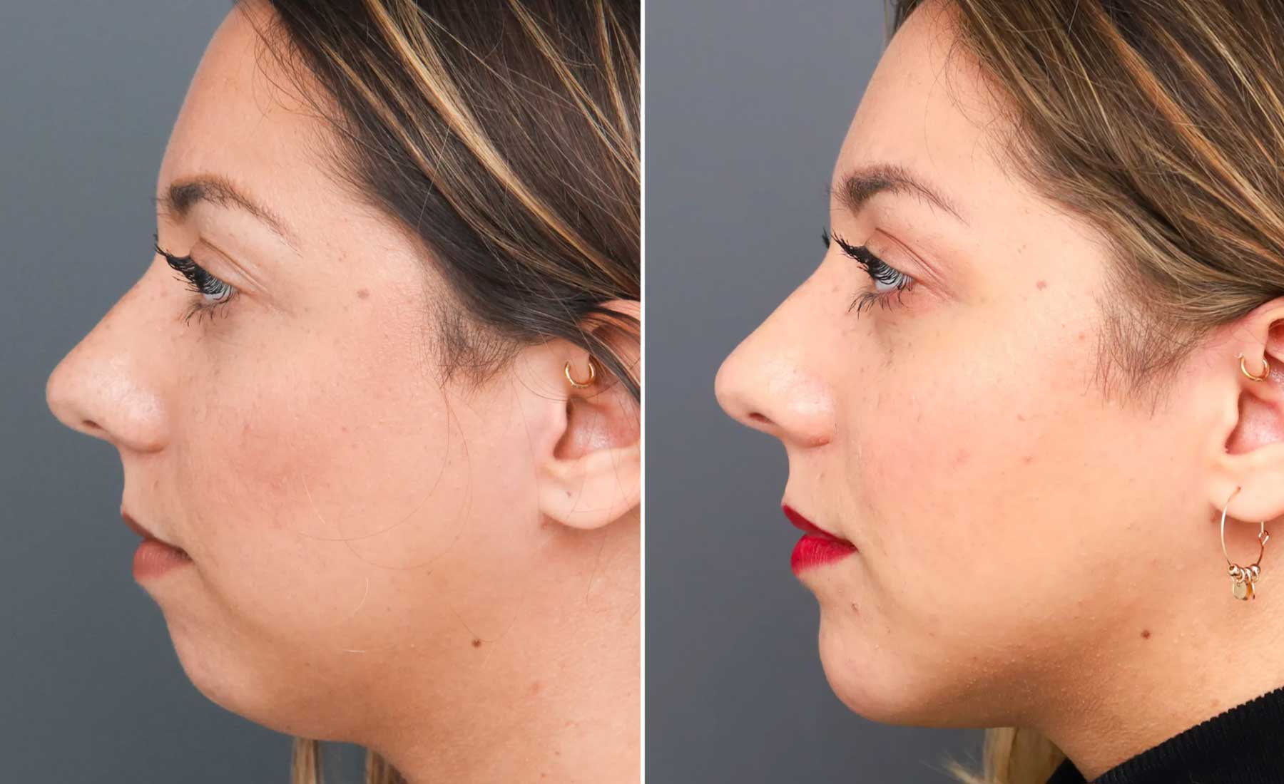 Chin Augmentation-Before and after