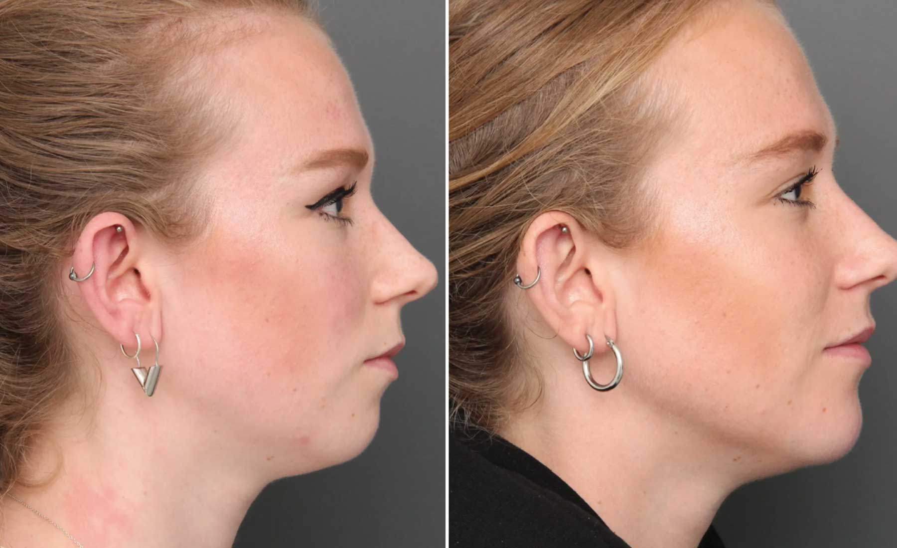 Chin Augmentation-Before and after