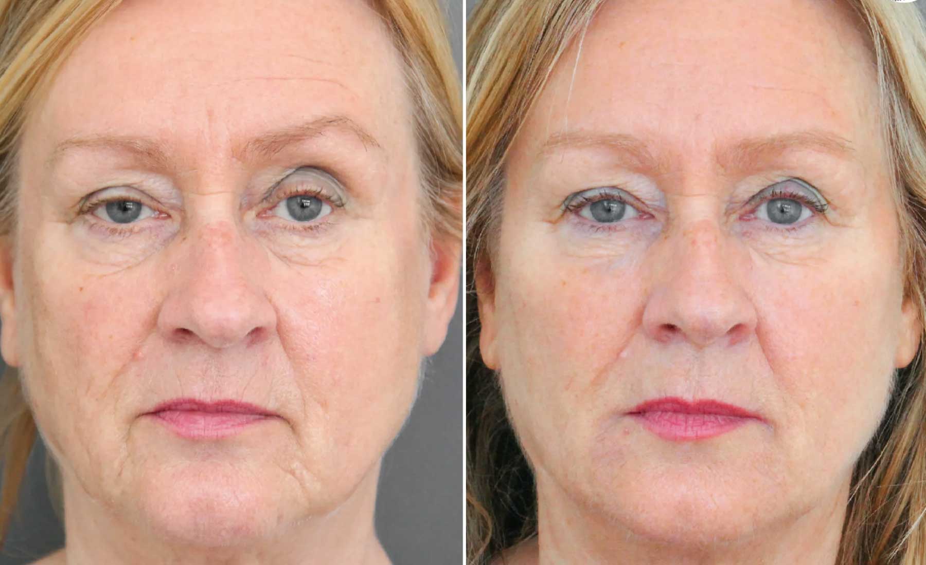 Chin Dimples and Pebbling-Before and after