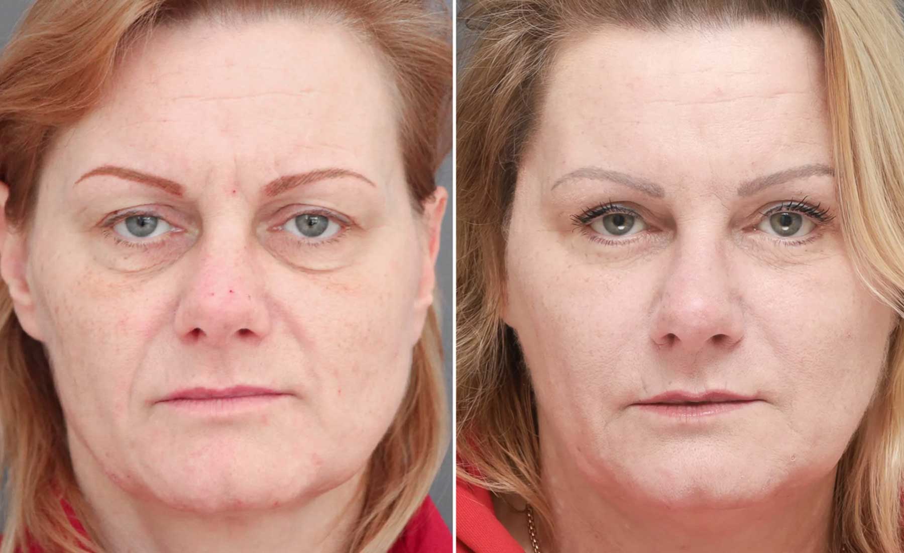 Chin Dimples and Pebbling-Before and after