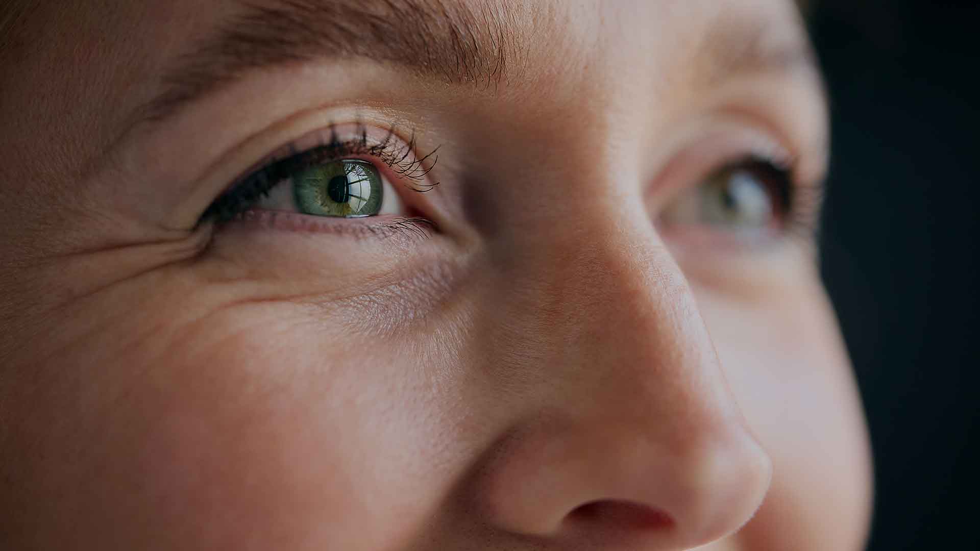 Crows-Feet-Monaz-Clinic