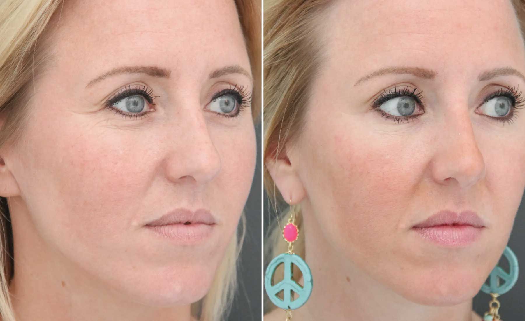 Crow's Feet (Periorbital Lines)‎-Before and after