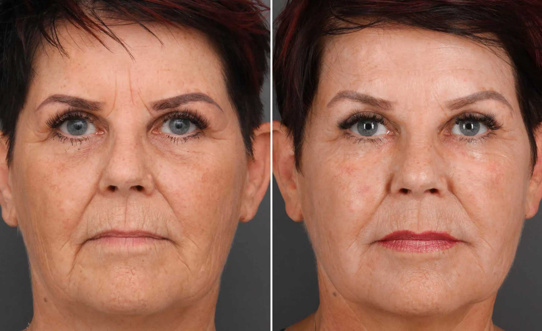 Crow's Feet (Periorbital Lines)‎-Before and after