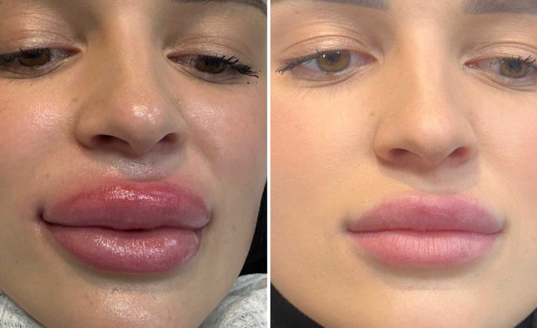 Dermal Filler Dissolving (Hyaluronidase Treatment)‎-Before and after