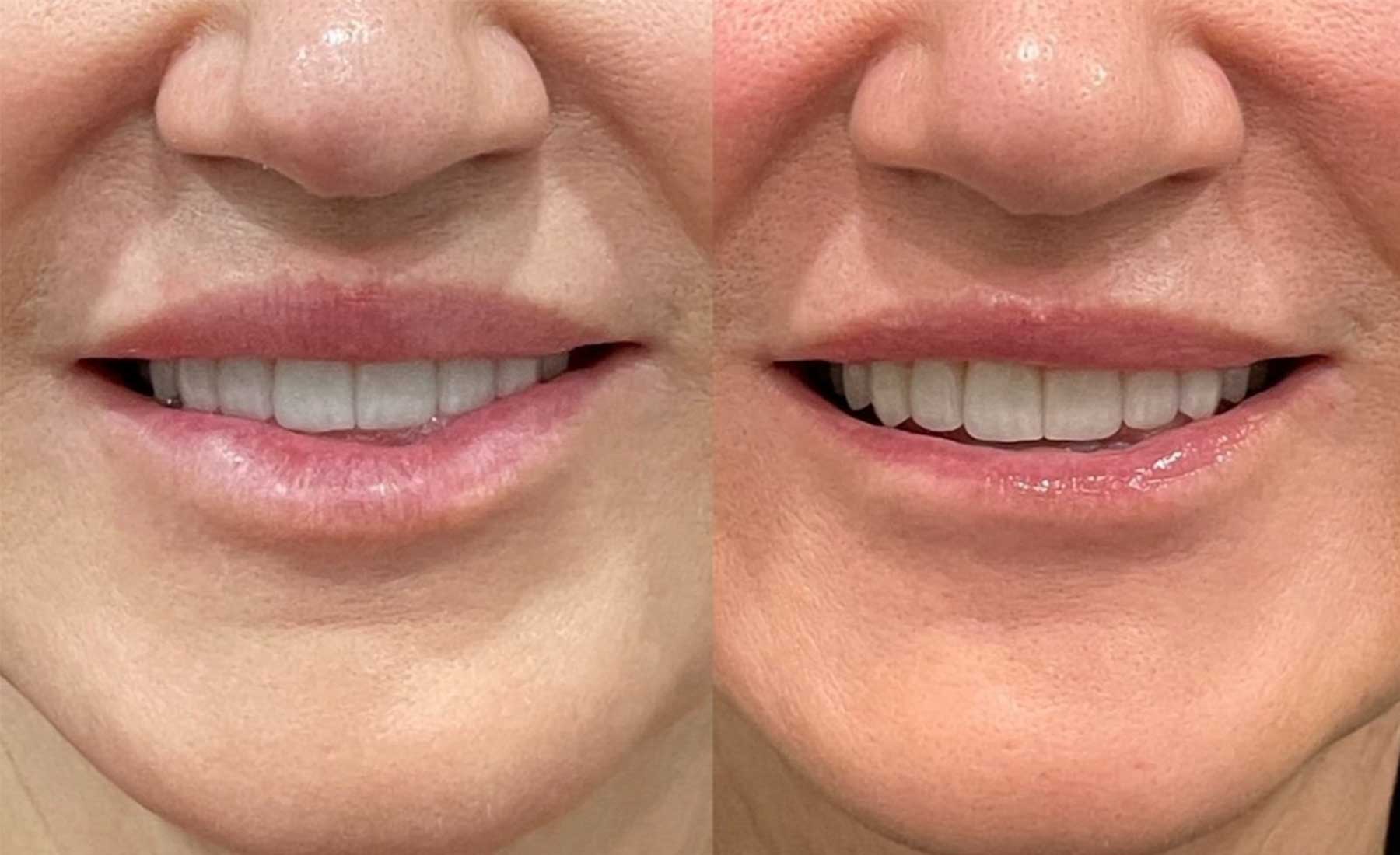 Dermal Filler Dissolving (Hyaluronidase Treatment)‎-Before and after