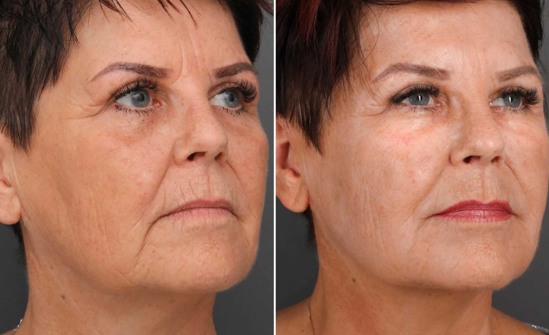 Downturned Mouth Corners-Before and after