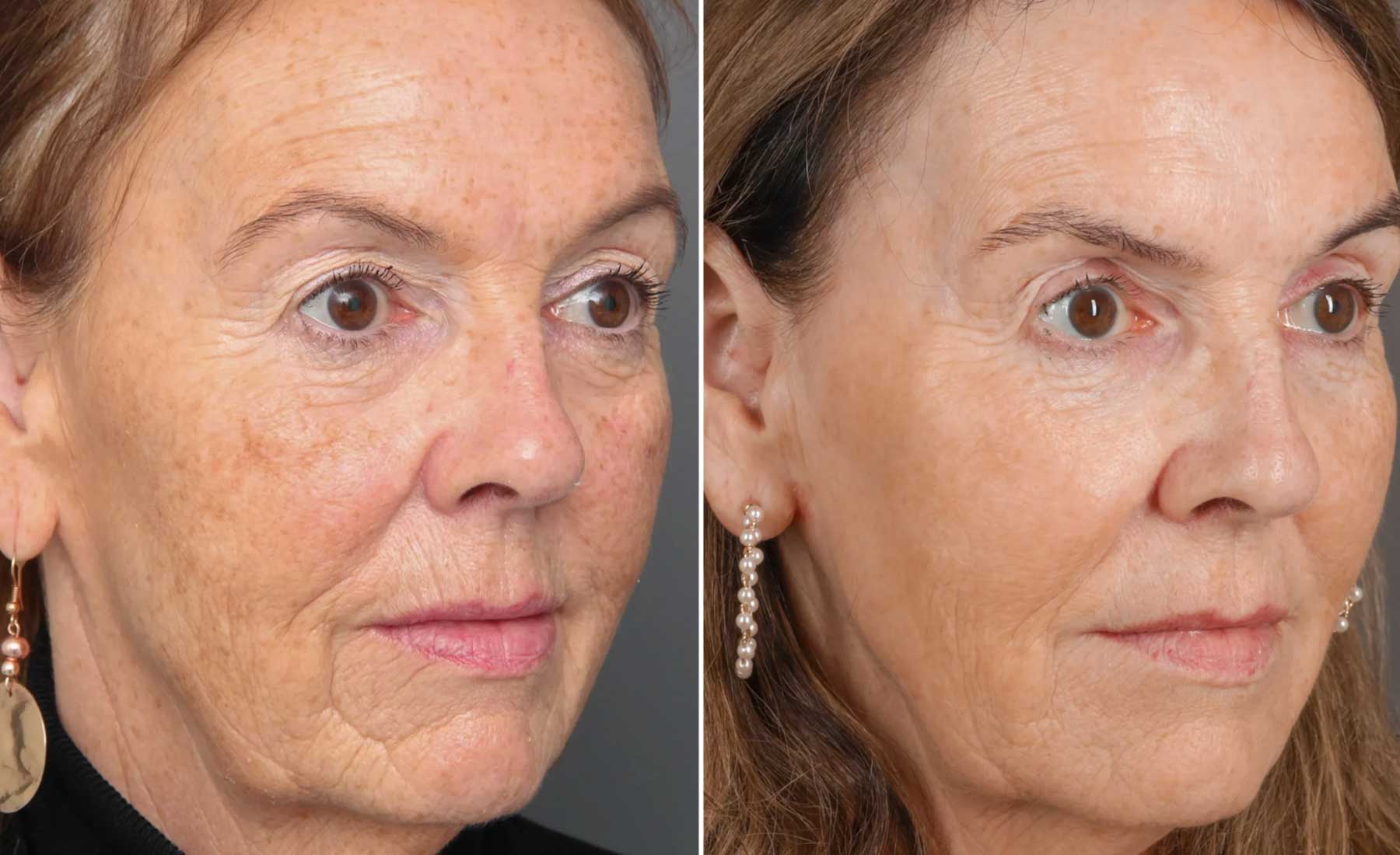 Full Facial Rejuvenation-Before and after