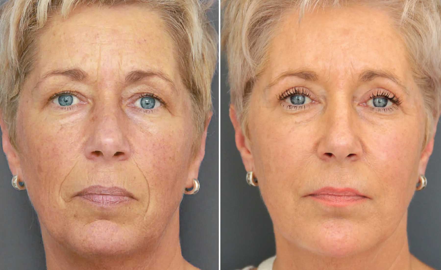 Full Facial Rejuvenation-Before and after