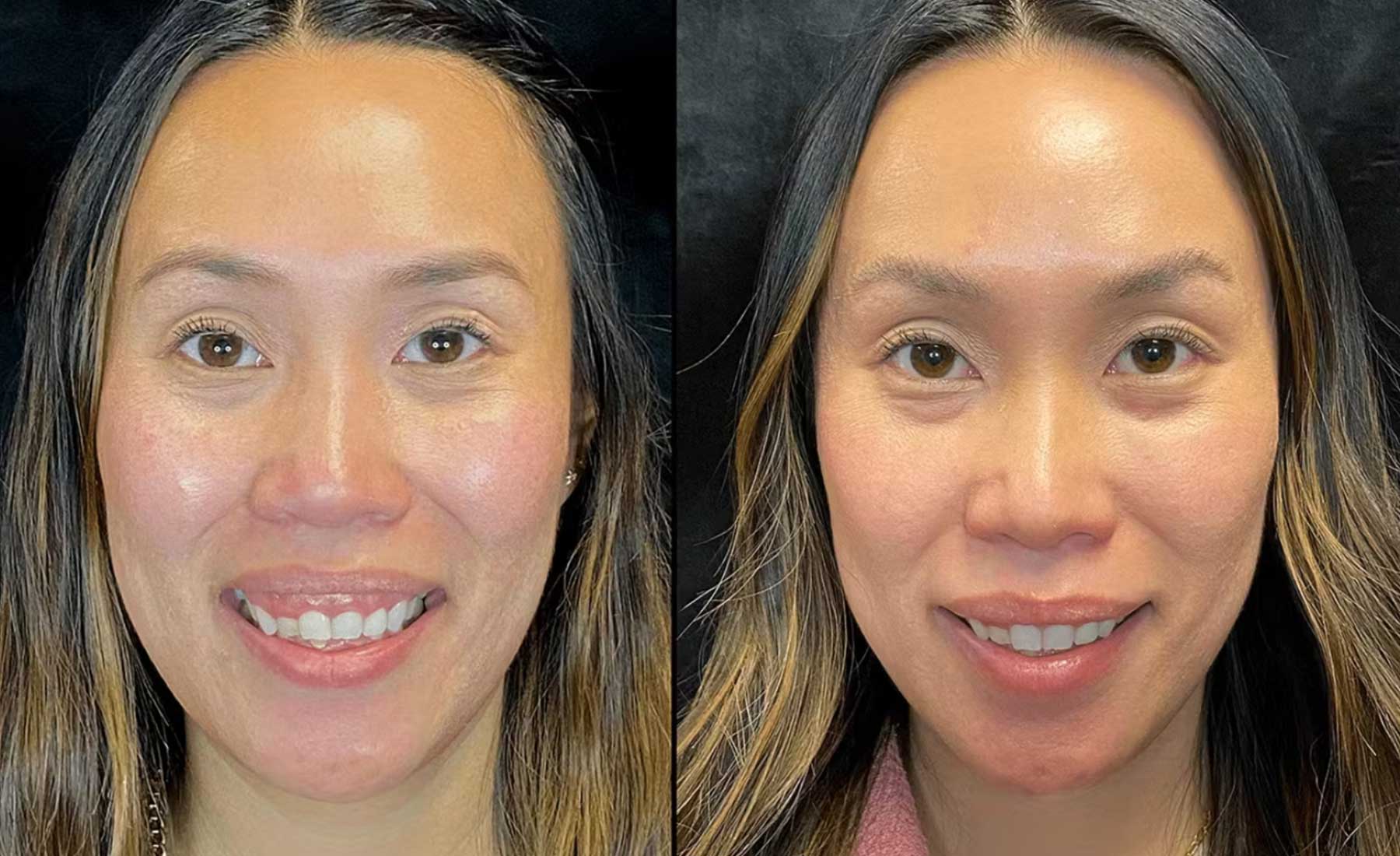 Gummy Smile Correction-Before and after
