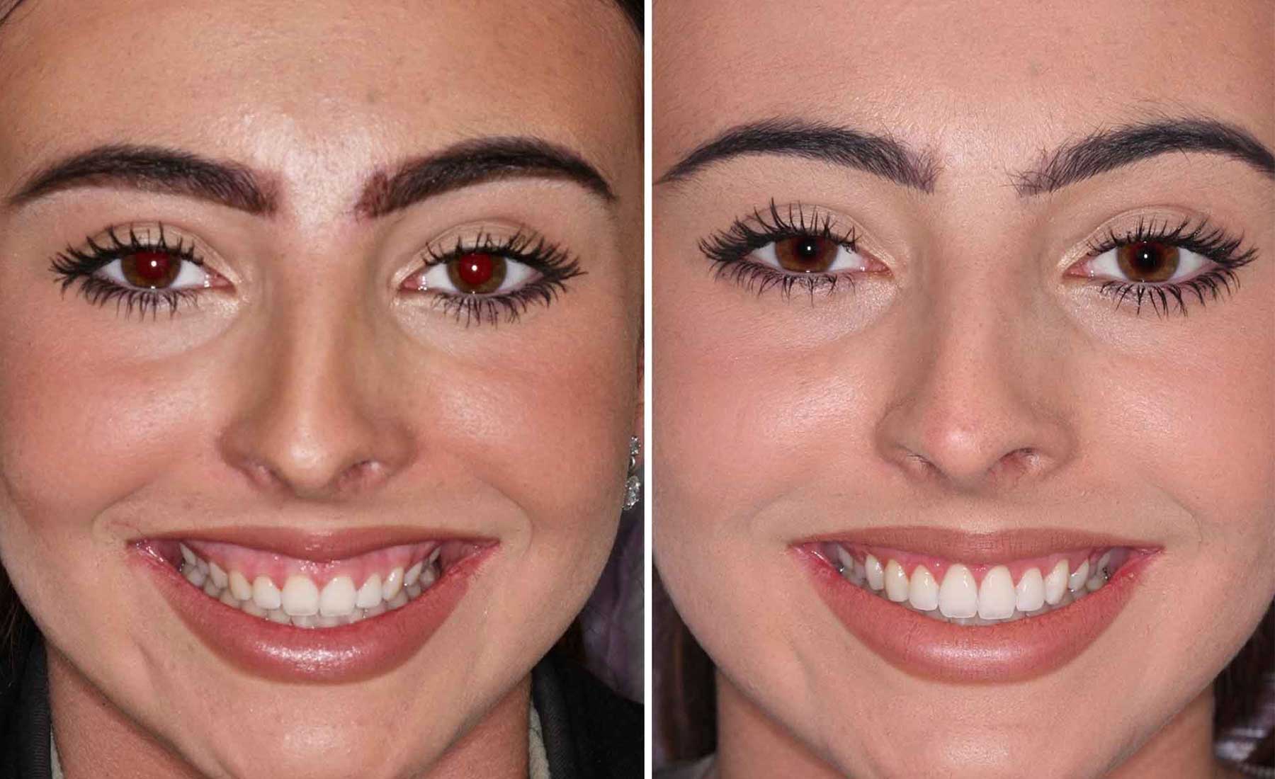 Gummy Smile Correction-Before and after
