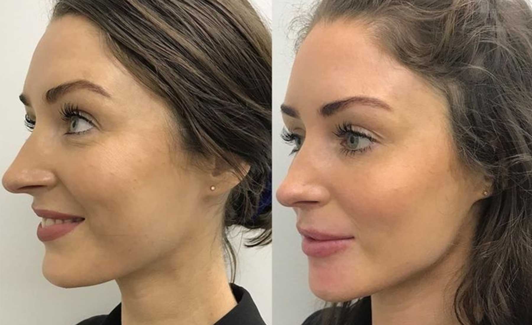 Jawline-Countouring-Before-and-after