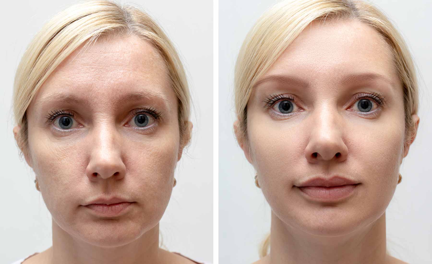 Lip-Enhancement-Before-and-After-3