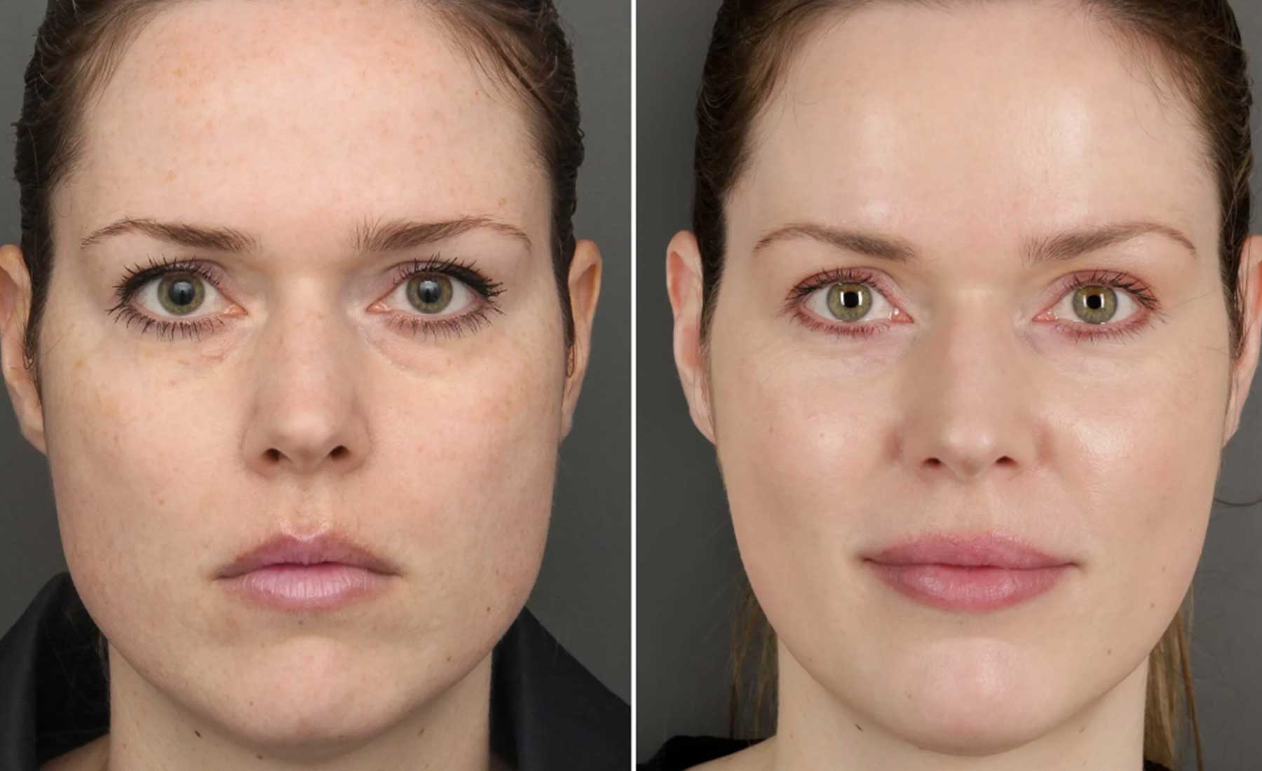 Lip Enhancement-Before and after