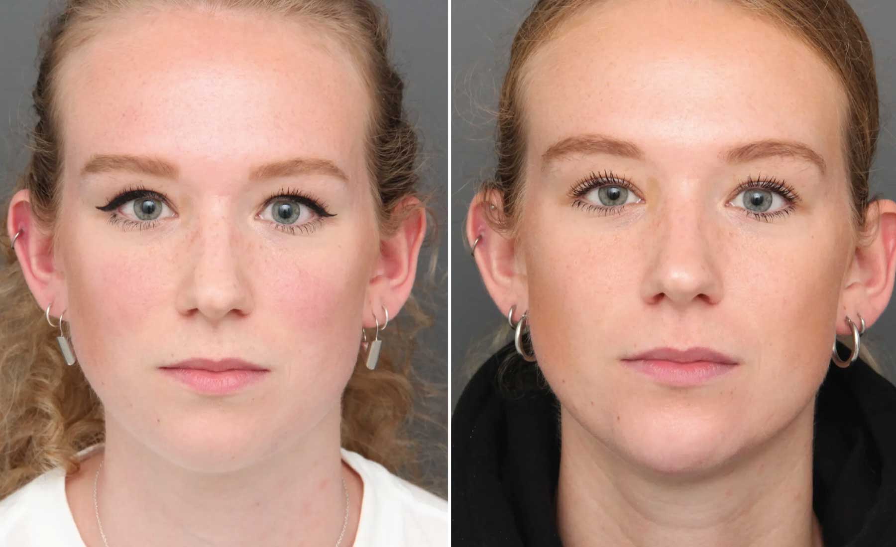 Masseter Reduction (Jaw Slimming)‎-Before and after