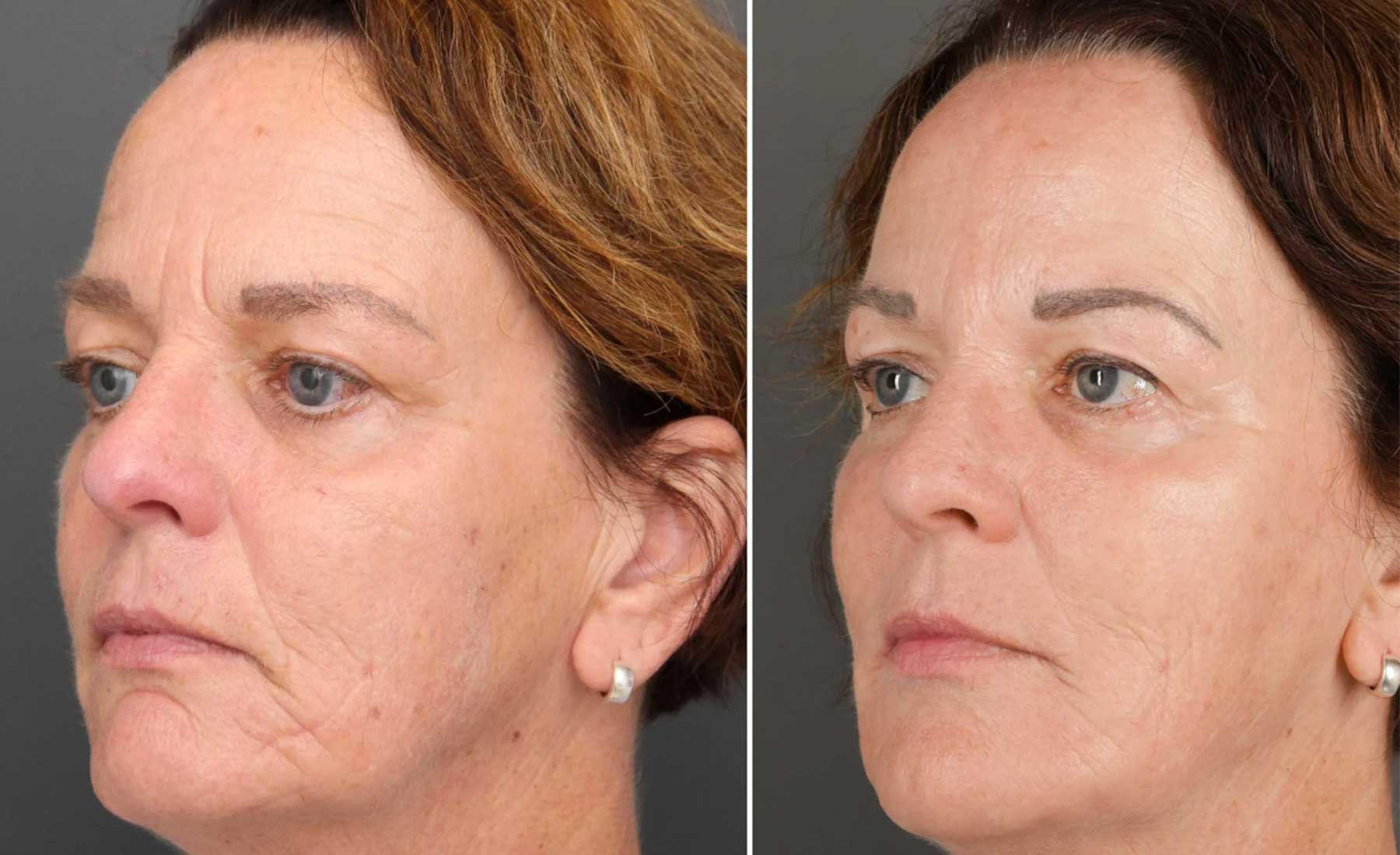 Masseter Reduction (Jaw Slimming)‎-Before and after