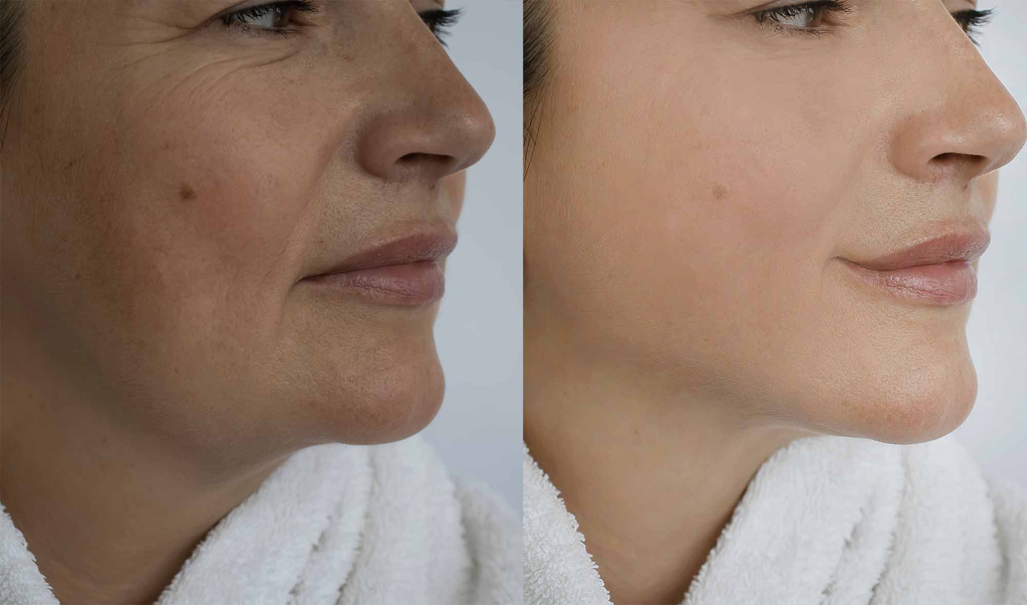 Monaz-clinic-Dermal-Fillers-for-Full-Facial-Rejuvenation