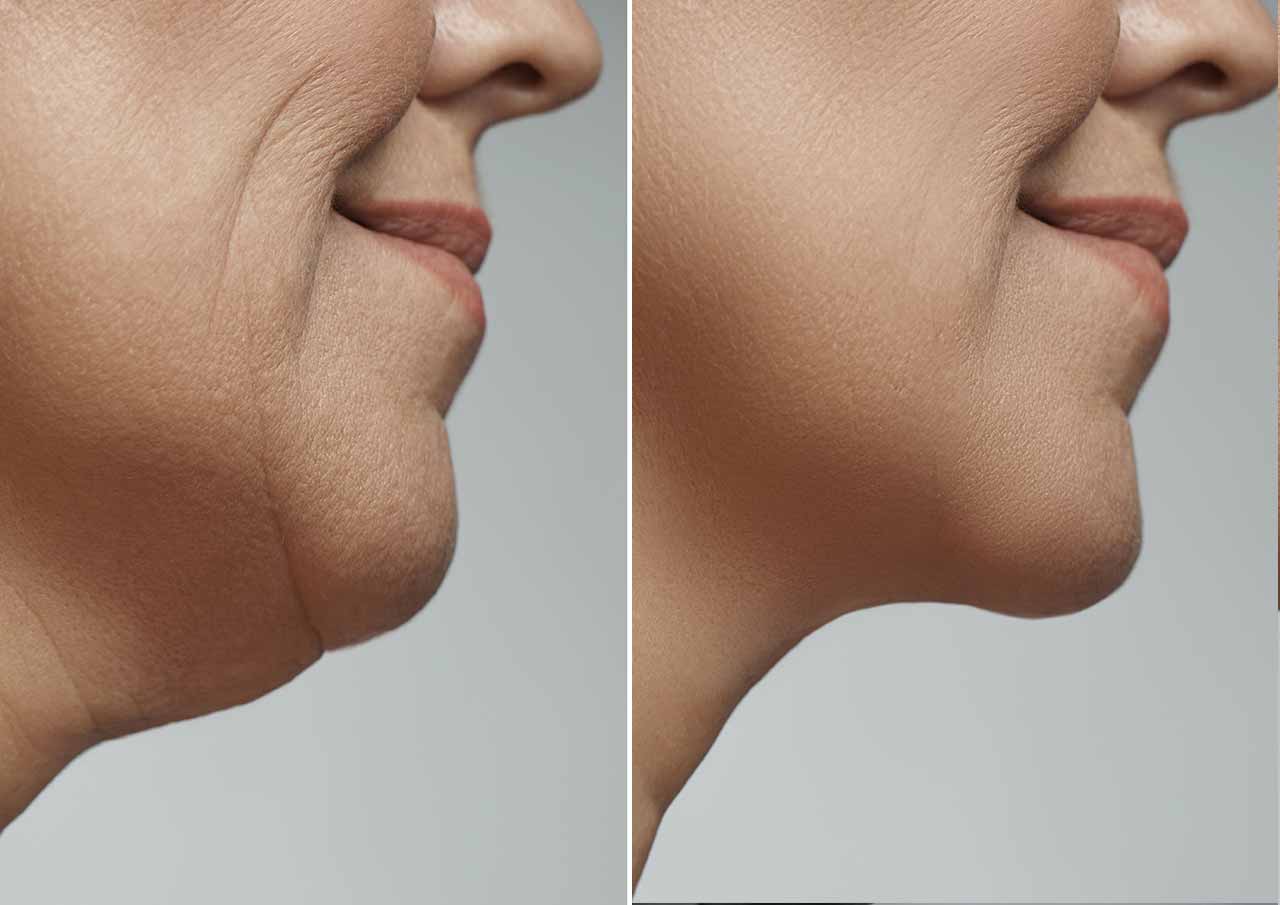 More-Defined-Chin-Without-Surgery
