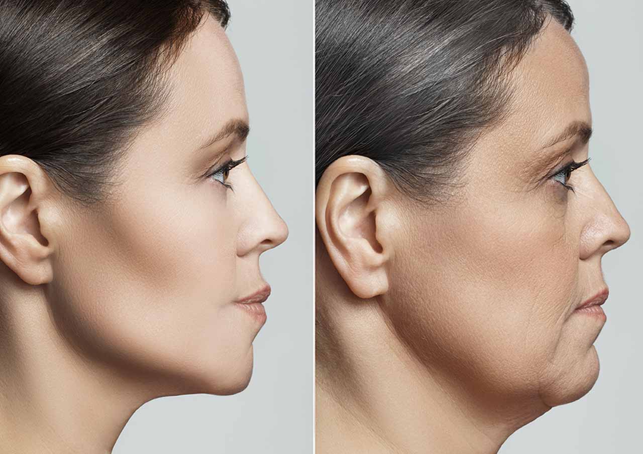 More-Sculpted-Jawline-Without-Surgery