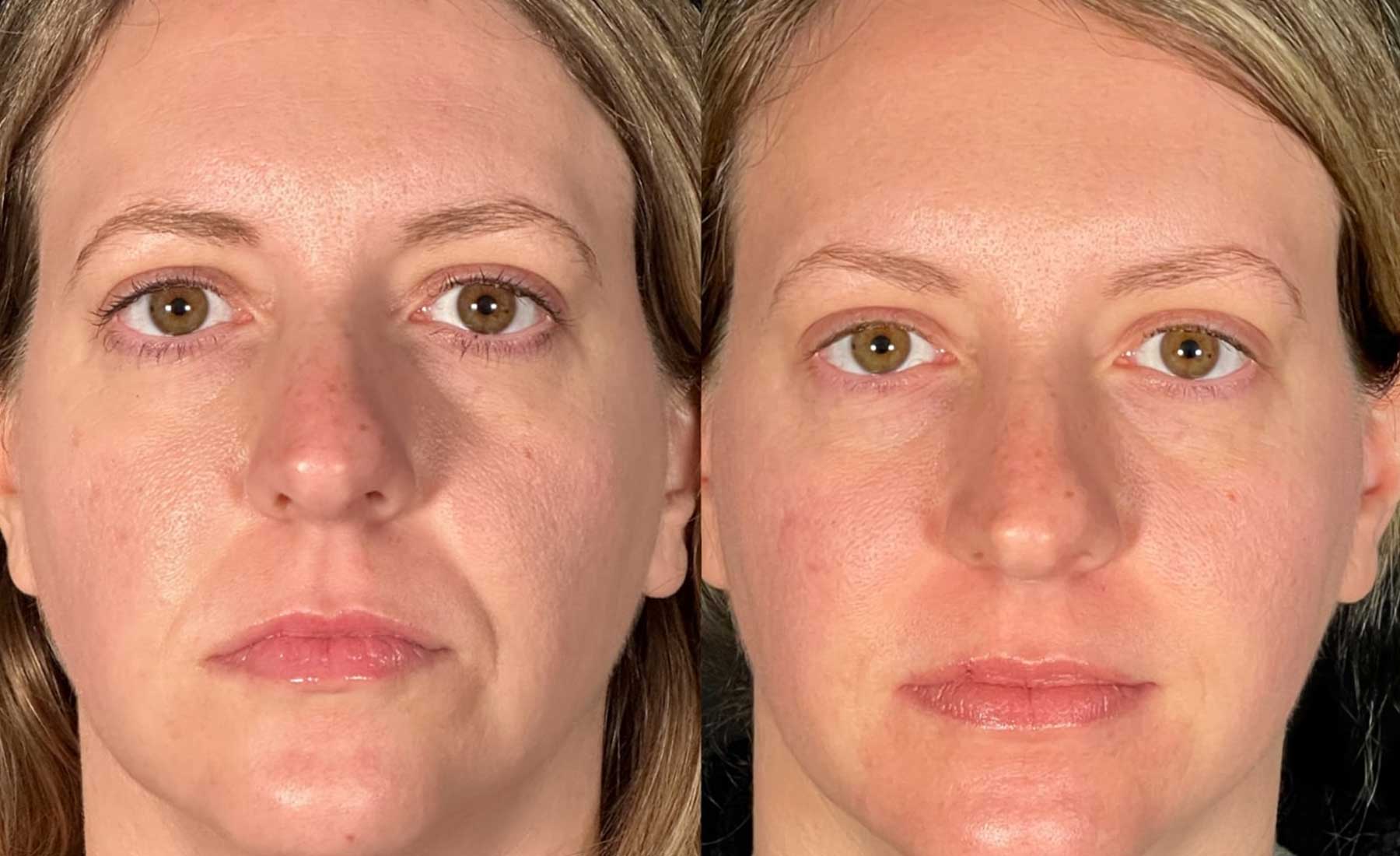 Nasolabial Folds (Smile Lines)‎-Before and after