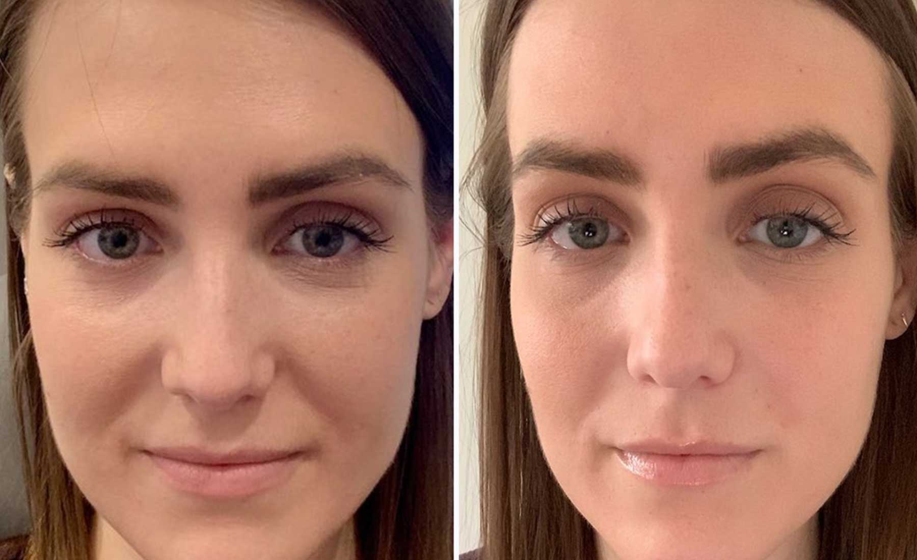 Nasolabial Folds (Smile Lines)‎-Before and after