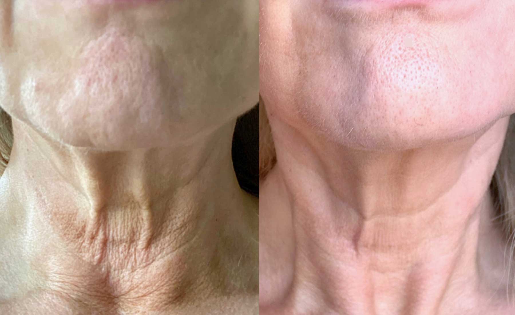 Nefertiti Neck Lift-Before and after