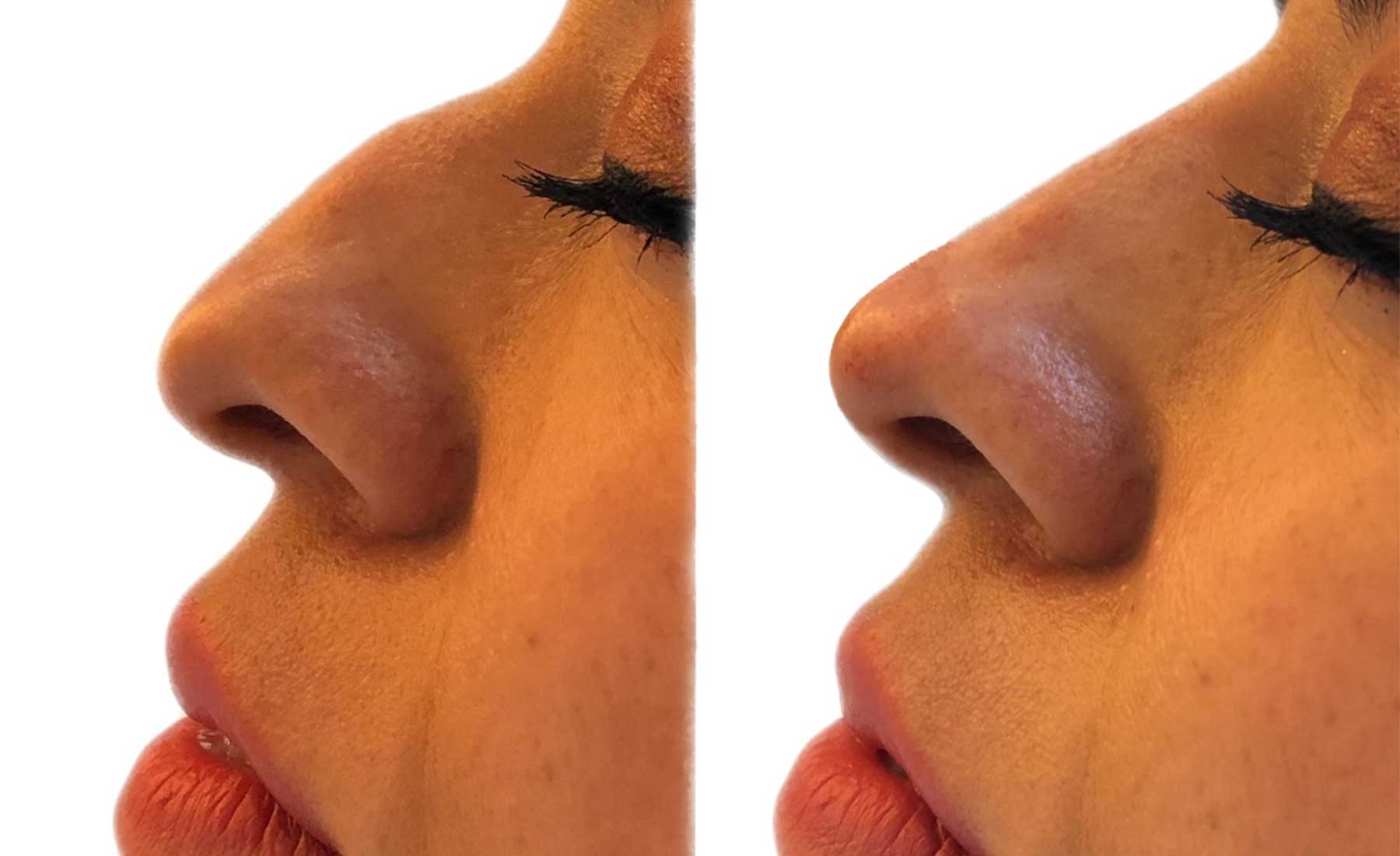 Non-Surgical Rhinoplasty (Nose Reshaping)‎-Before and after