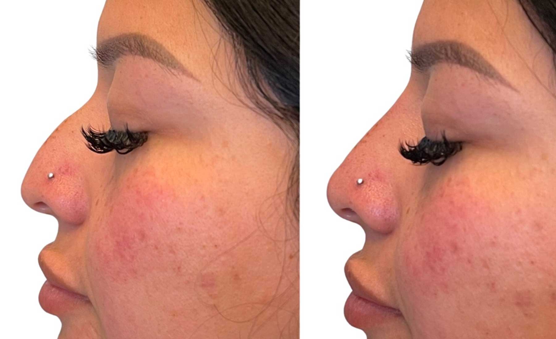 Non-Surgical Rhinoplasty (Nose Reshaping)‎-Before and after