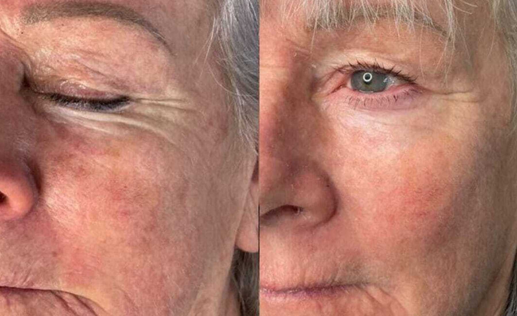 Polynucleotide Therapy-Before and after-1