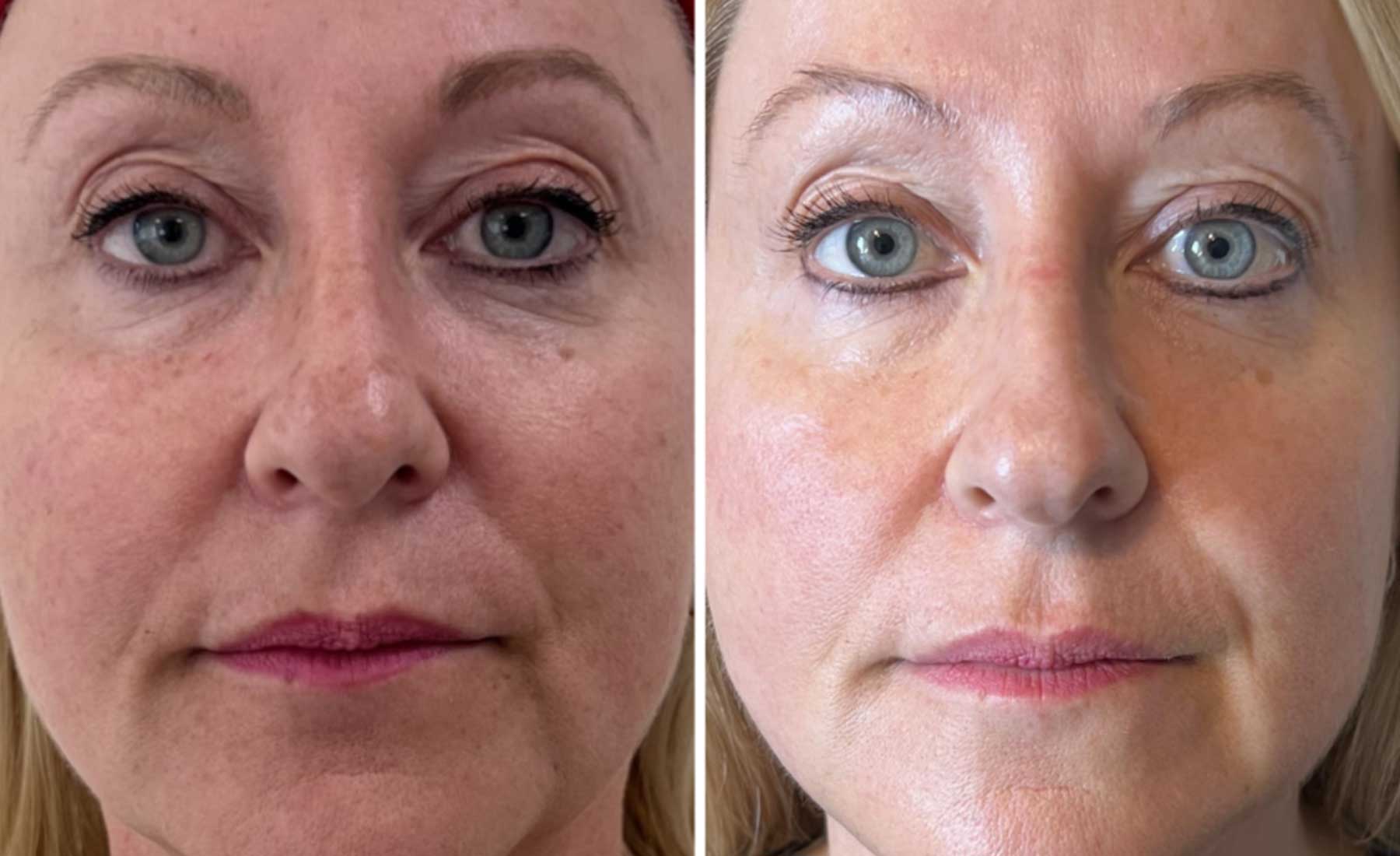 Polynucleotide Therapy-Before and after