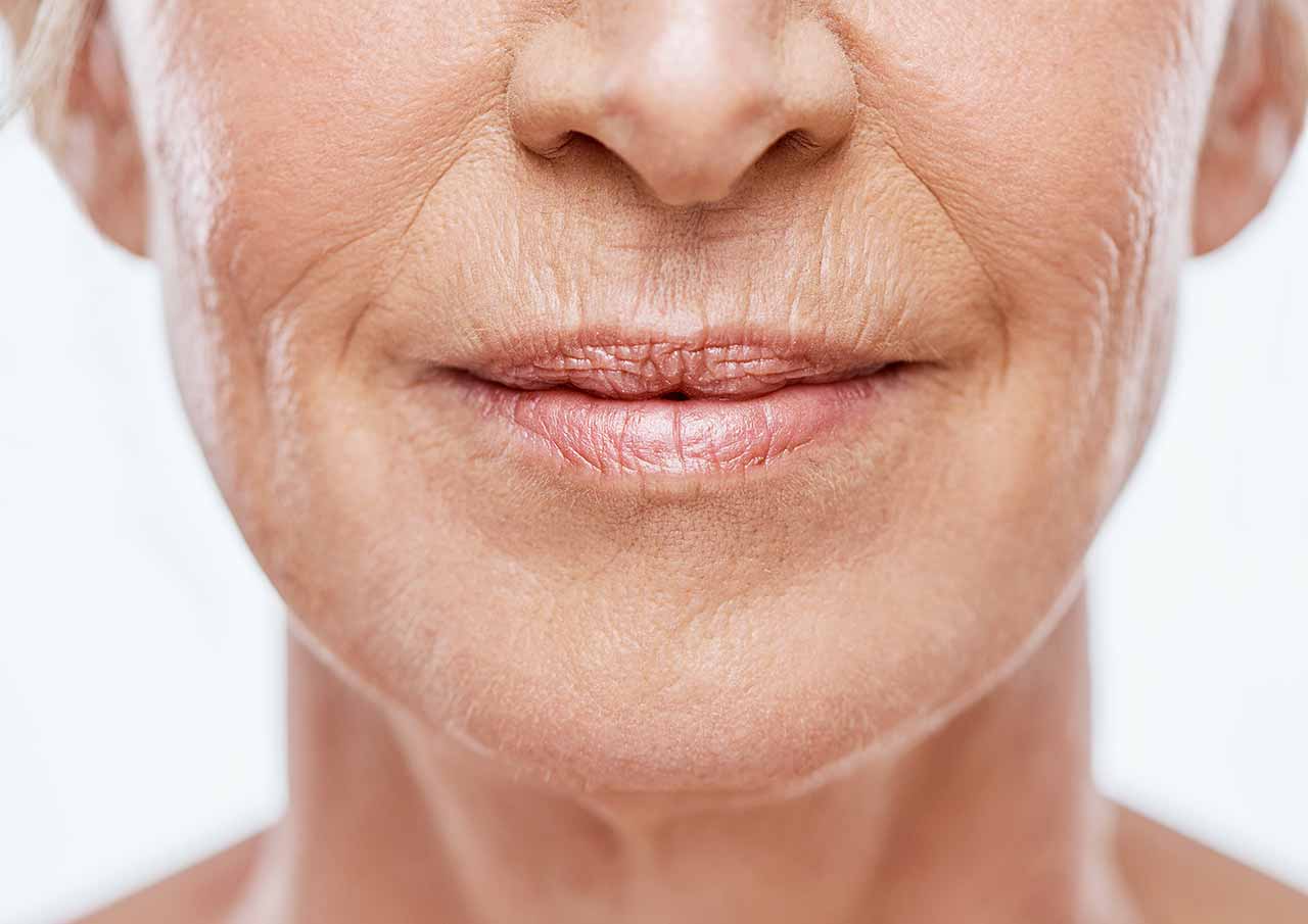 Smokers Lines Affecting Your Confidence