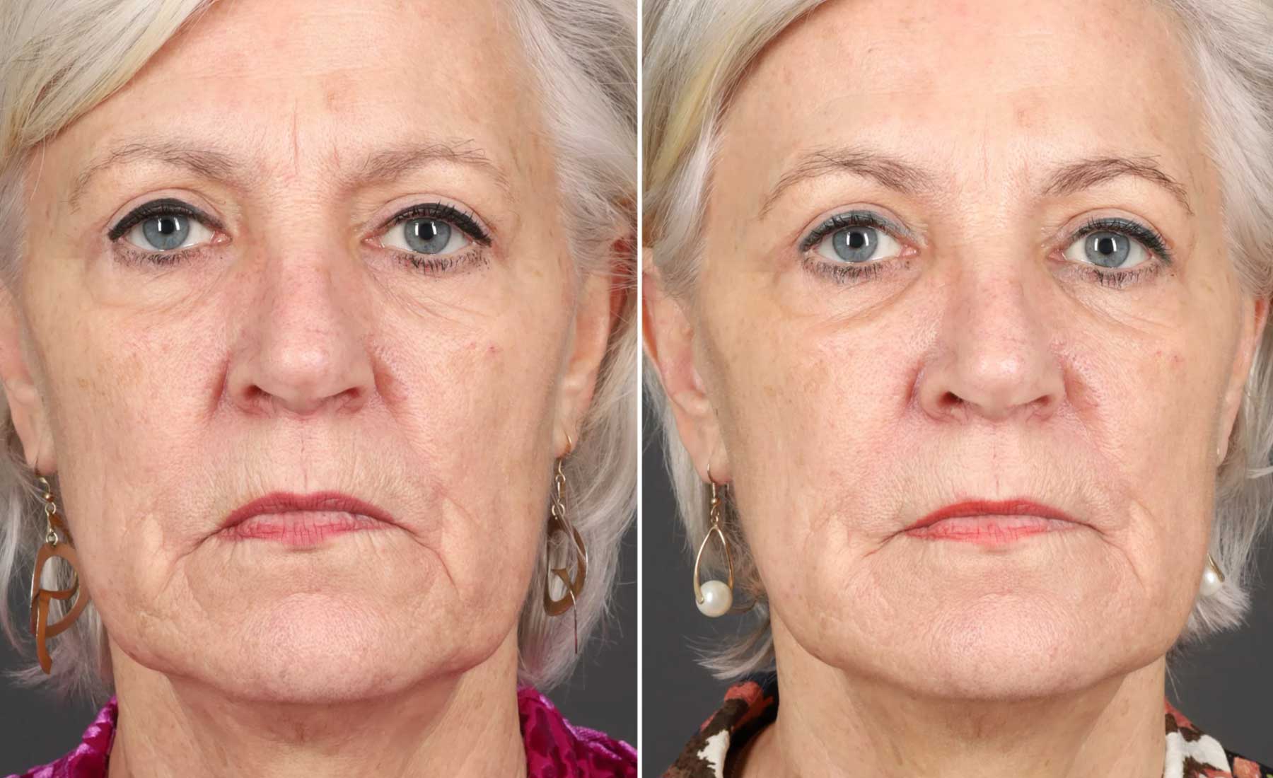 Smokers' Lines (Perioral Lines)‎-Before and after