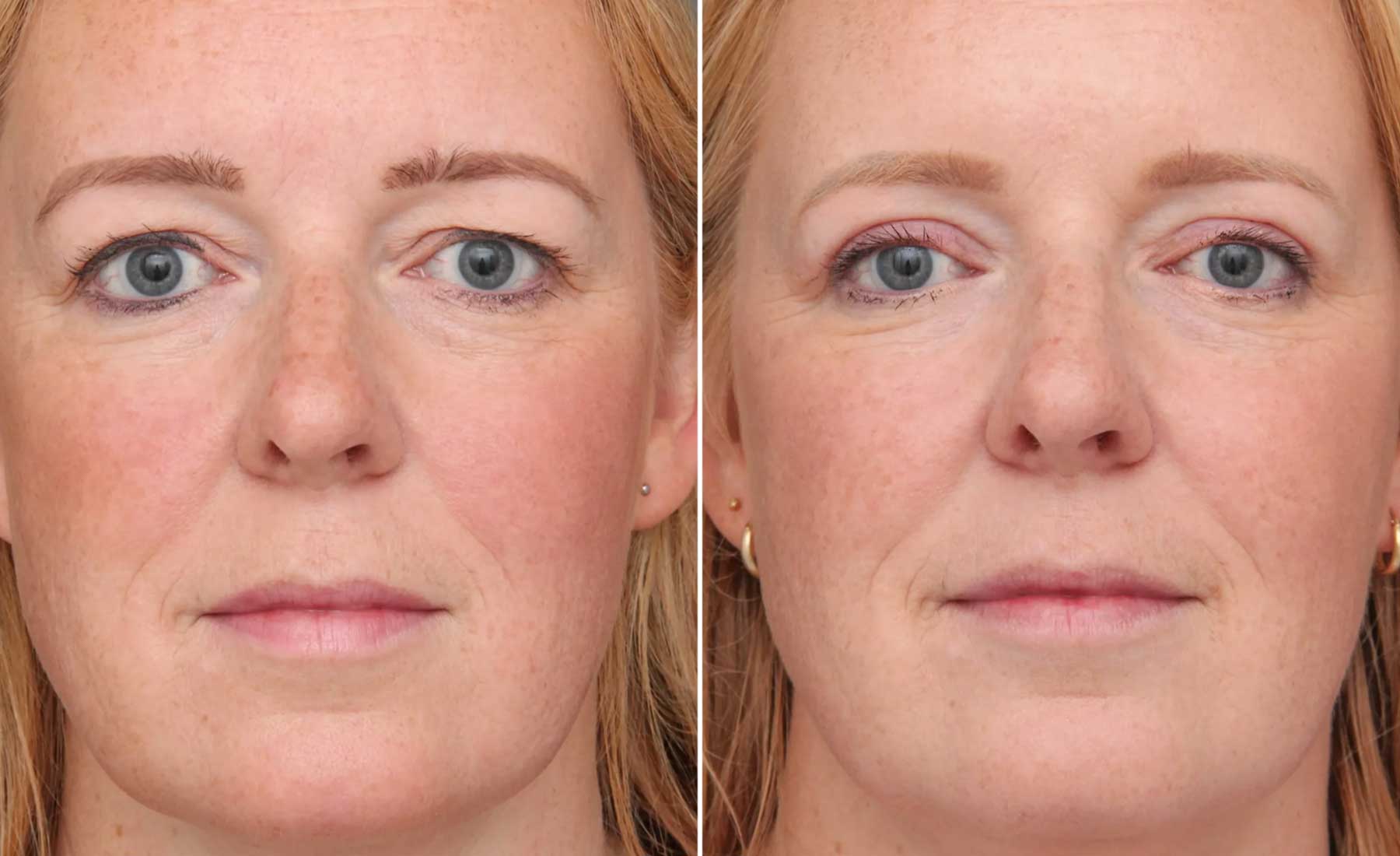 Tear Trough Treatment (Under-Eye Hollows)‎-Before and after