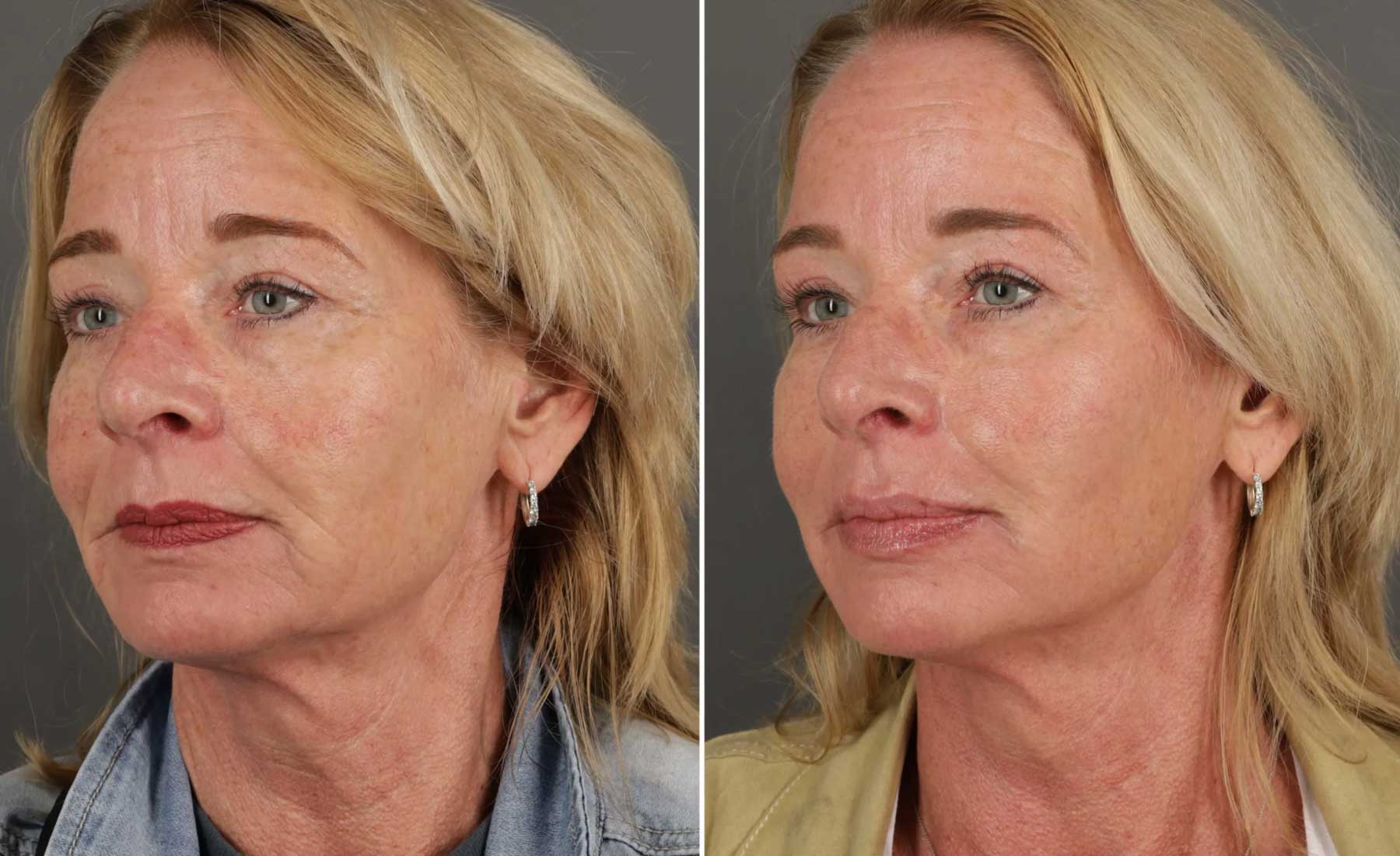 Temple Volume Restoration-Before and after