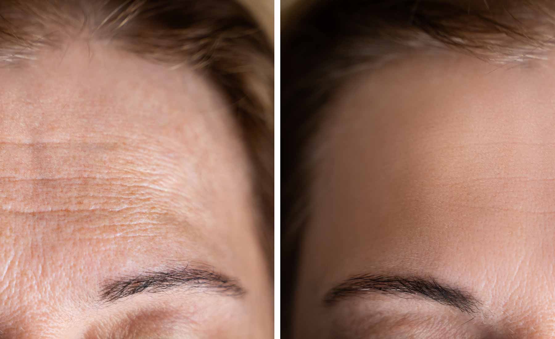 forehead-lines-before-after-3