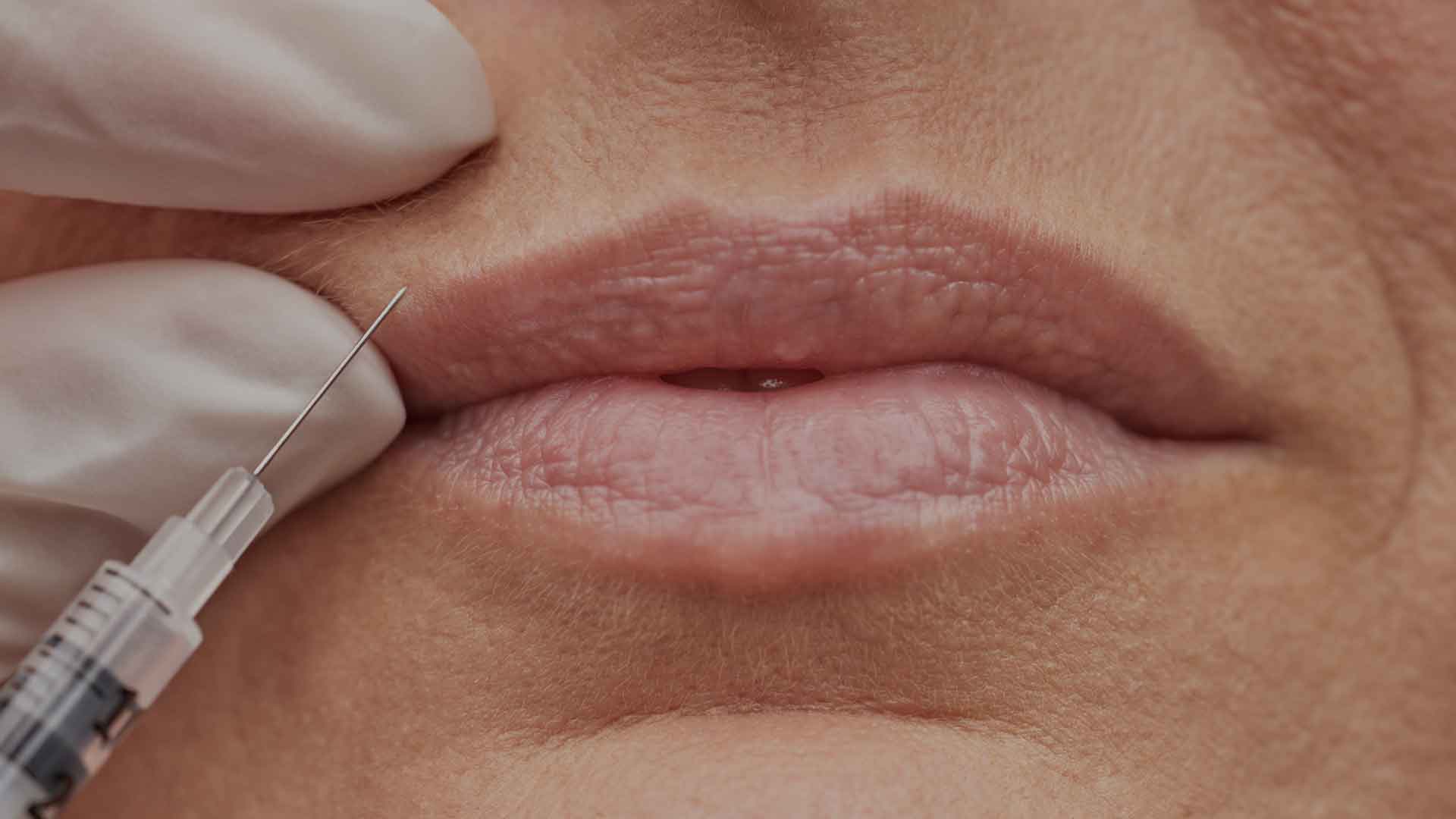 smokers-lines-monaz-clinic